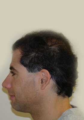 hair transplant photos