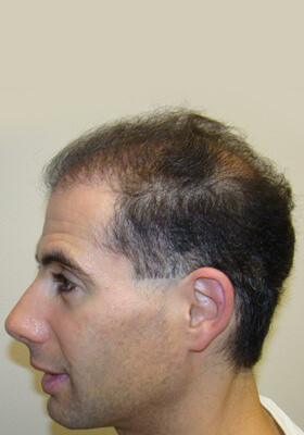 hair transplant photos