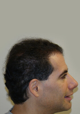 hair transplant photos