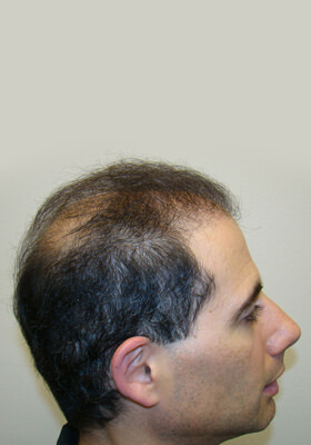 hair transplant photos