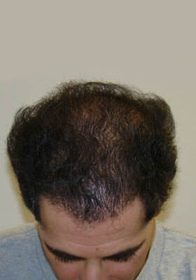 hair transplant photos