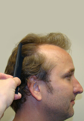 hair transplant photos