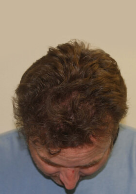 hair transplant before after Photos