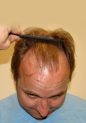 hair transplant photos