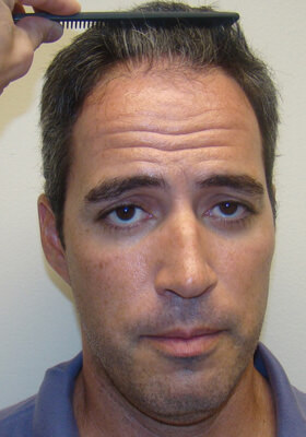 hair transplant photos