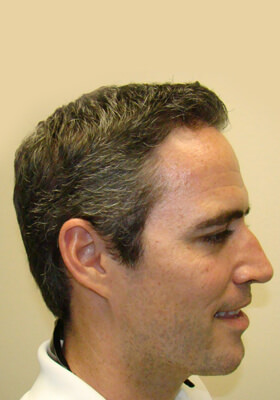 hair transplant photos