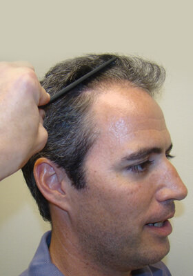 hair transplant photos