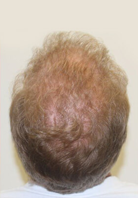 hair transplant photos