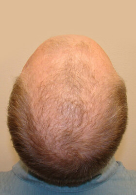 hair transplant photos