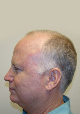 hair transplant photos