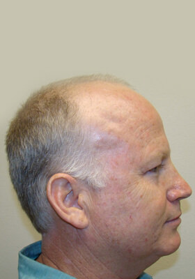 hair transplant photos