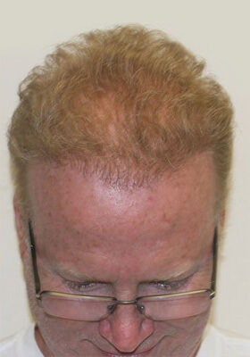 hair transplant photos