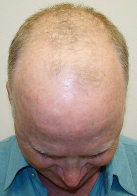 hair transplant before after Photos