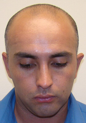 hair transplant photos