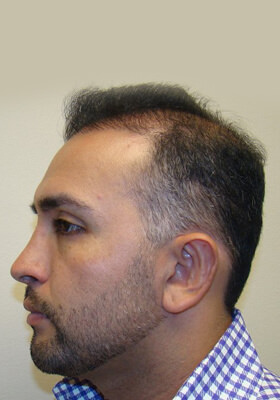 hair transplant photos