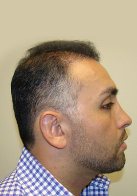 hair transplant photos