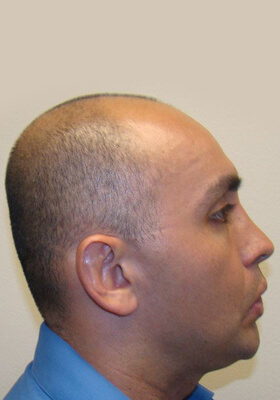 hair transplant photos