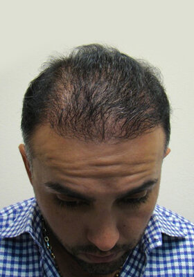 hair transplant before after Photos