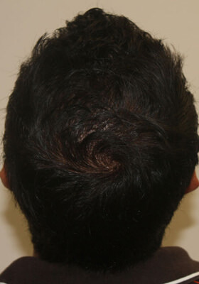 hair transplant photos