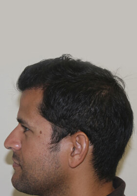 hair transplant photos