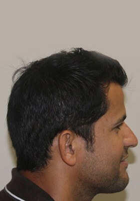 hair transplant photos