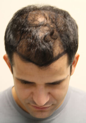 hair transplant before after Photos