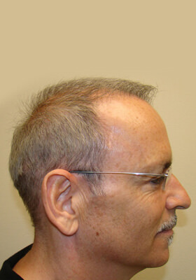 hair transplant photos