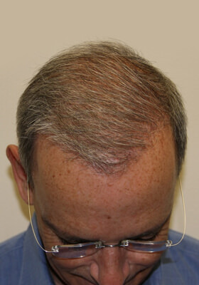 hair transplant before after Photos