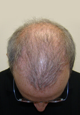 hair transplant photos