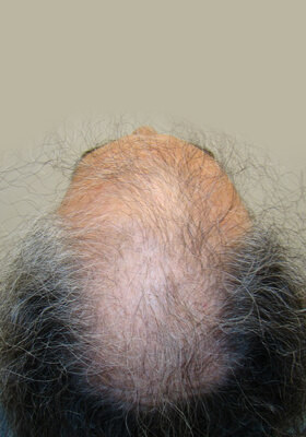 hair transplant photos