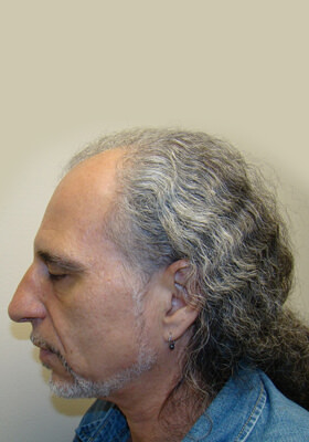 hair transplant photos