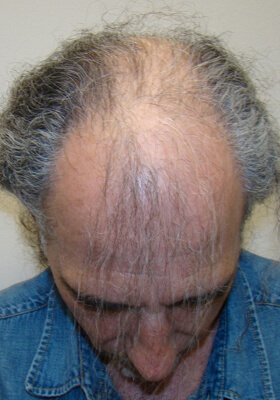 hair transplant before after Photos