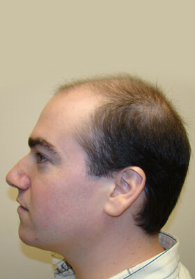 hair transplant photos