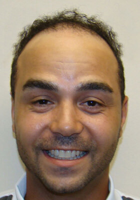 hair transplant photos