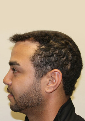 hair transplant photos