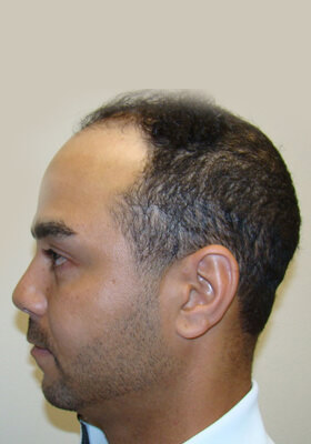 hair transplant photos