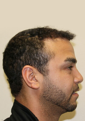 hair transplant photos