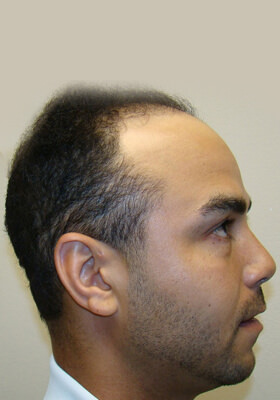 hair transplant before after Photos