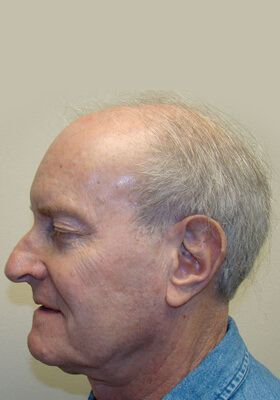 hair transplant photos