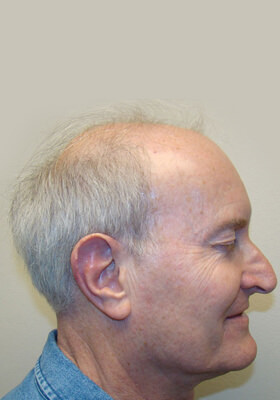 hair transplant photos