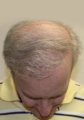 hair transplant photos