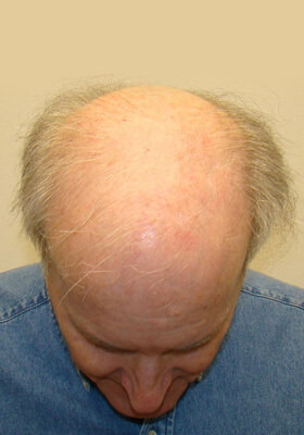 hair transplant photos