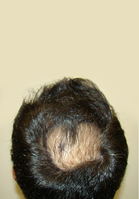 hair transplant photos