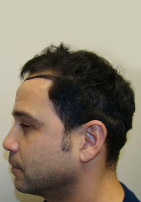 hair transplant photos