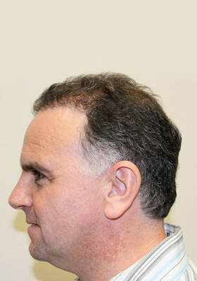 hair transplant photos