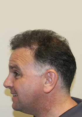 hair transplant photos