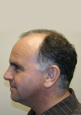 hair transplant photos