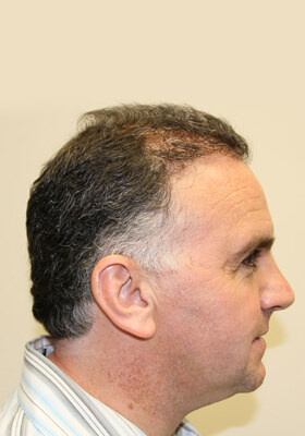 hair transplant photos