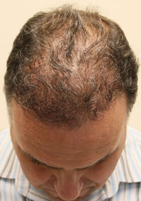 hair transplant photos