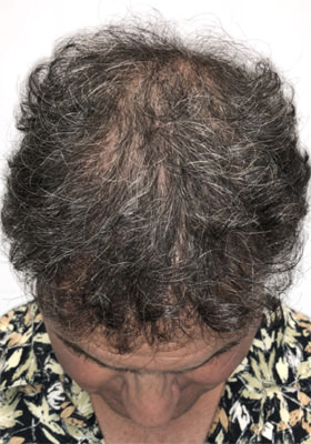 hair transplant photos